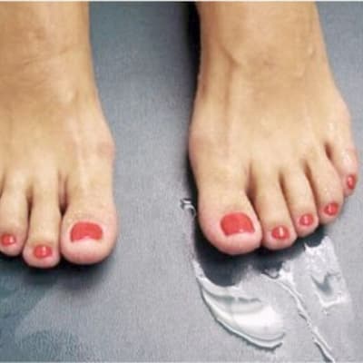 fit feet podiatrists larne hyperhidrosis
