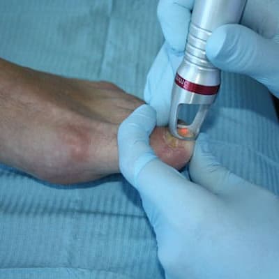 fit feet podiatrists larne northern ireland fungal nail treatments 400